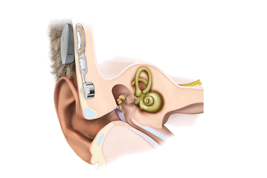 非植入骨导助听器图片